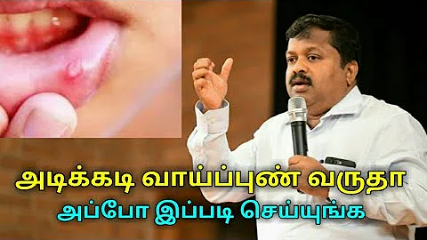 | Dr.Sivaraman speech on mouth ulcer treatment