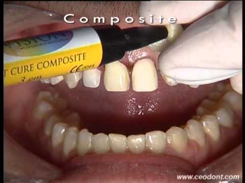 Ceodont Estética Dental: Cementado de Carillas de Porcelana en un caso  clínico con Diastemas - YouTube