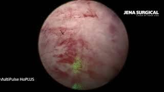 HoLEP. Case of a giant adenoma, vol.360 cm3. 3-lobe technique.Time of enucleation 54 min  A.Gonyaev.