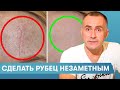 Как избавиться от рубцов на лице (шрамы, акне, послеоперационные) Хирург Караванов Дмитрий