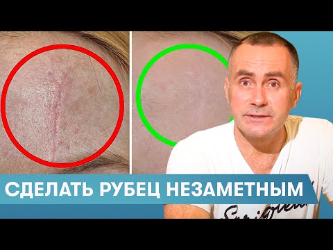 Видео: Как избавиться от пореза на лице (с картинками)