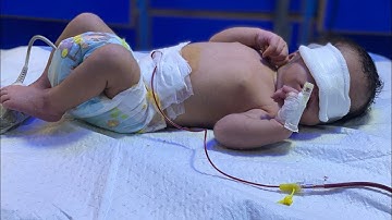 Exchange Transfusion in Newborn | Step by Step Procedure Explained