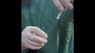 Subcutaneous Fat Embolization for Management of Coronary Perforation During Retrograde CTO-PCI