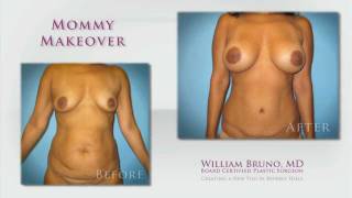 Mommy Makeover Beverly Hills | Dr. William Bruno