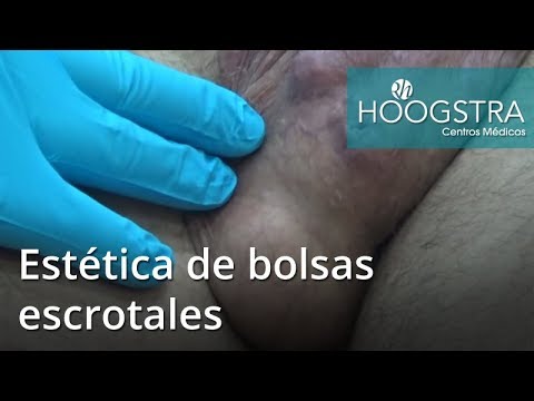 quiste sebaceo del escroto quiste sebaceo del escroto