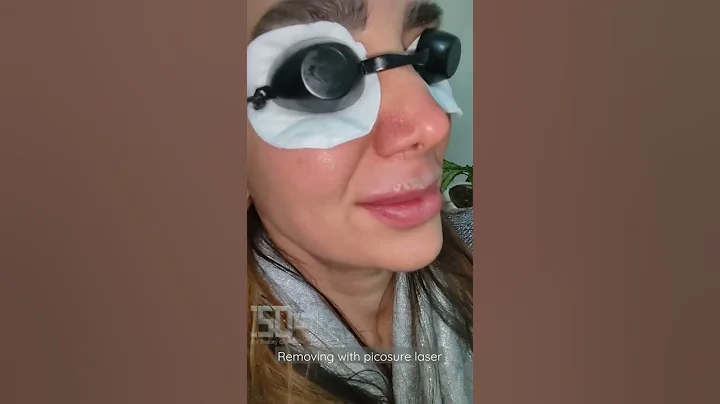 removing her lips tattoos with picosure laser⚡