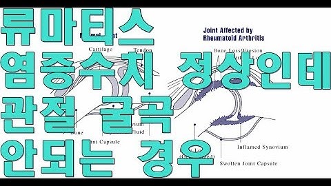 류마티스관절염 염증수치와 조조강직과 관절움직임 Rheumatoid Arthritis