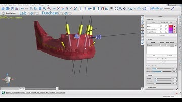 Bone reduction guide & Implant surgical guide (trailer)