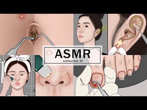 ASMR Body Treatments! Navel Stone, Ingrown Toenail,  Ear Cleaning, Blackheads | Meng's Stop Motion