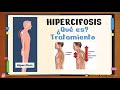 ✅ CIFOSIS e HIPERCIFOSIS dorsal (explicación) Ejercicios para corregir