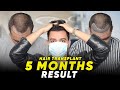 Hair transplant in india  best results  cost of hair transplant in india