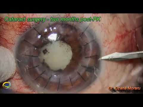 How to Eye surgery Penetrating Keratoplasty on  Perforated Cornea | What is the use of keratoplasty?