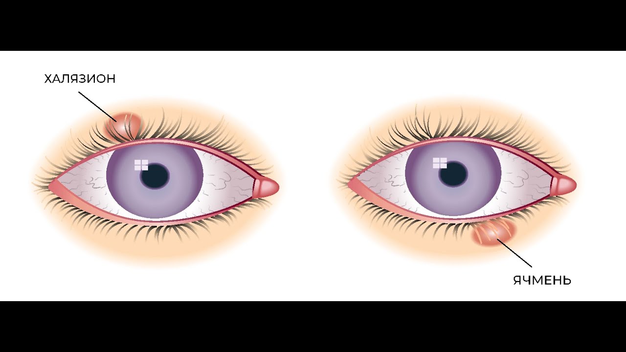 Халязион Фото Лечение — Картинки фотографии