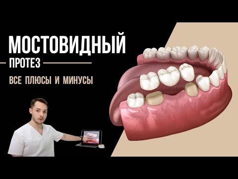 Почему мост на зубы лучше не ставить❓