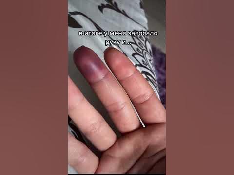 сломала палец - YouTube