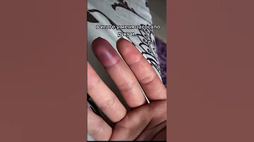сломала палец 