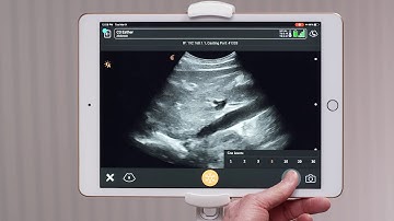 Clarius Feature: Capturing Cine Clips