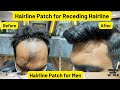 Hair Patch in Kolkata | Hairline Patch for Men | Indian Hair World
