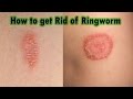 Ringworm Treatment At Home : 7 Steps on How to Cure Ringworm Fast!