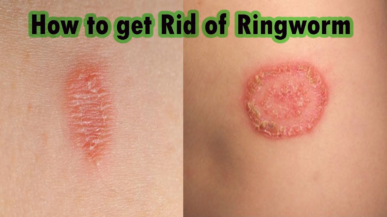 How to Treat Ringworm on a Tattoo at Home - wide 1