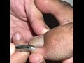 Ingrown removal (Pinoy style)