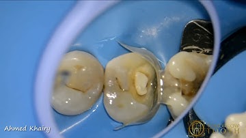 Overmolding in Class II Composite Restoration