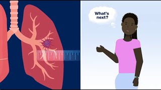 What Happens After Your Doctor Finds a Lung Nodule (Pulmonary Nodule)? by American Lung Association 14,403 views 2 months ago 1 minute, 52 seconds