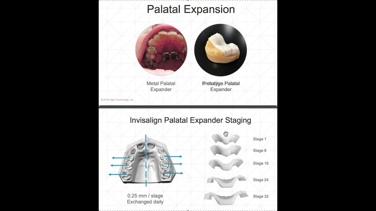 Invisalign Align Technology New RPE Palatal Expander Prototype
