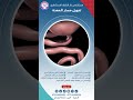 تحويل مسار المعدة