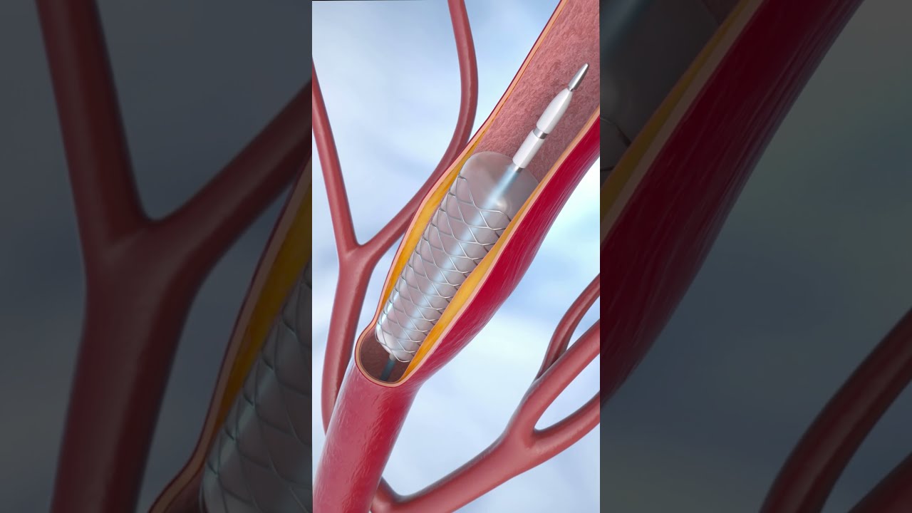 Coronary Angioplasty And Stent Insertion Animation Shorts Anatomy Science Asmr