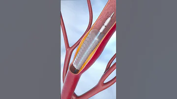 Coronary Angioplasty And Stent Insertion Animation Shorts Anatomy Science Asmr 