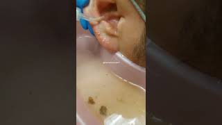 earwax cerumen earwaxremoval relax satisfying satisfyingvideo earwaxcleaning doctoraescucha