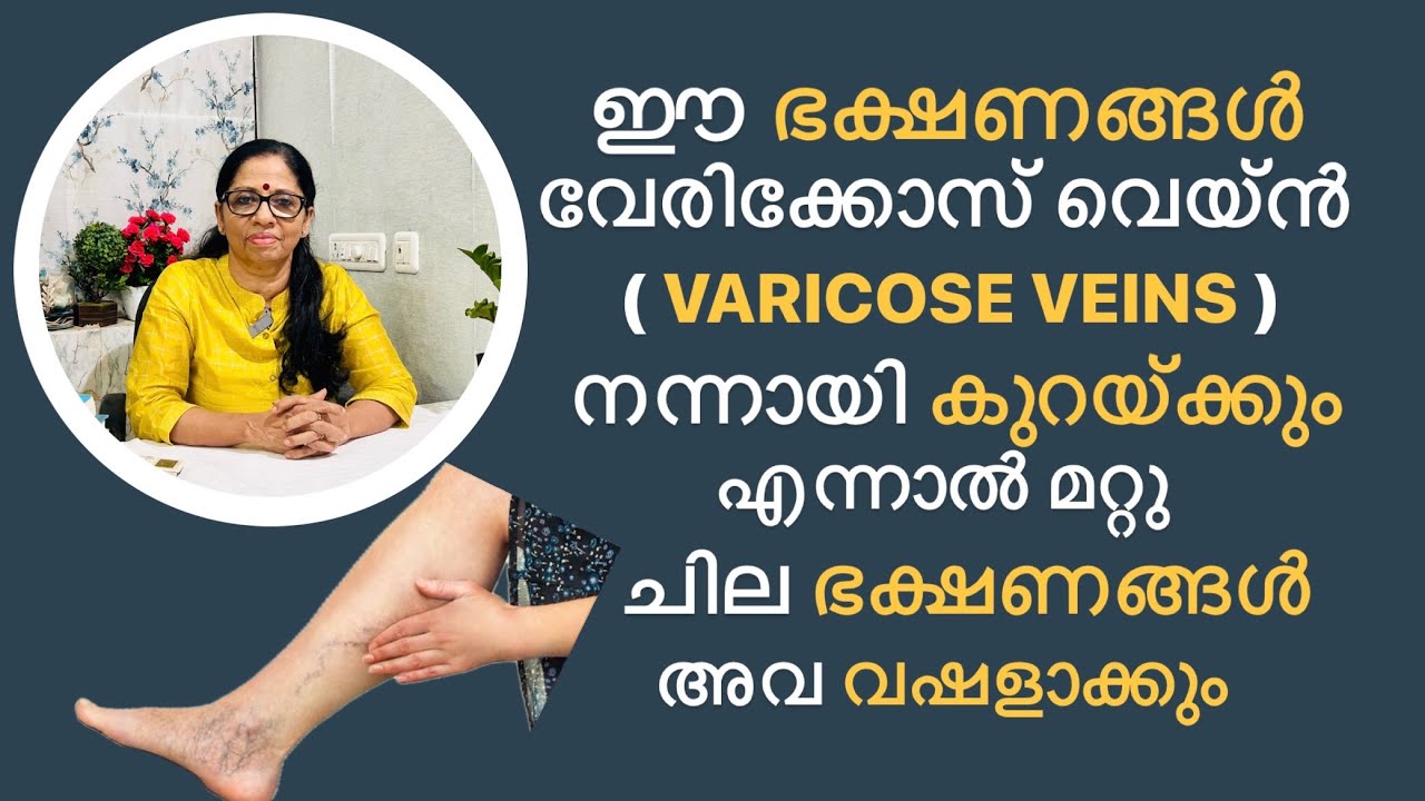 Food habits and Lifestyle modifications to be made for Varicose Veins.. (VNo: 316)