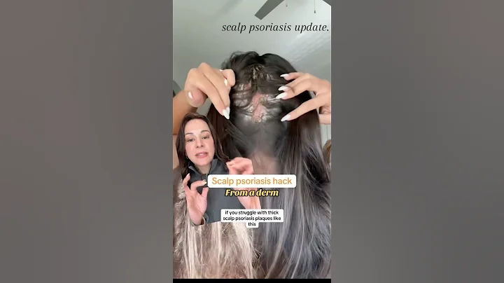 Scalp Psoriasis HACK — From A Derm | #shorts #skincare |