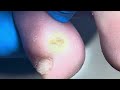 There Is A Wart On The Toe, Dig It Out Carefully
