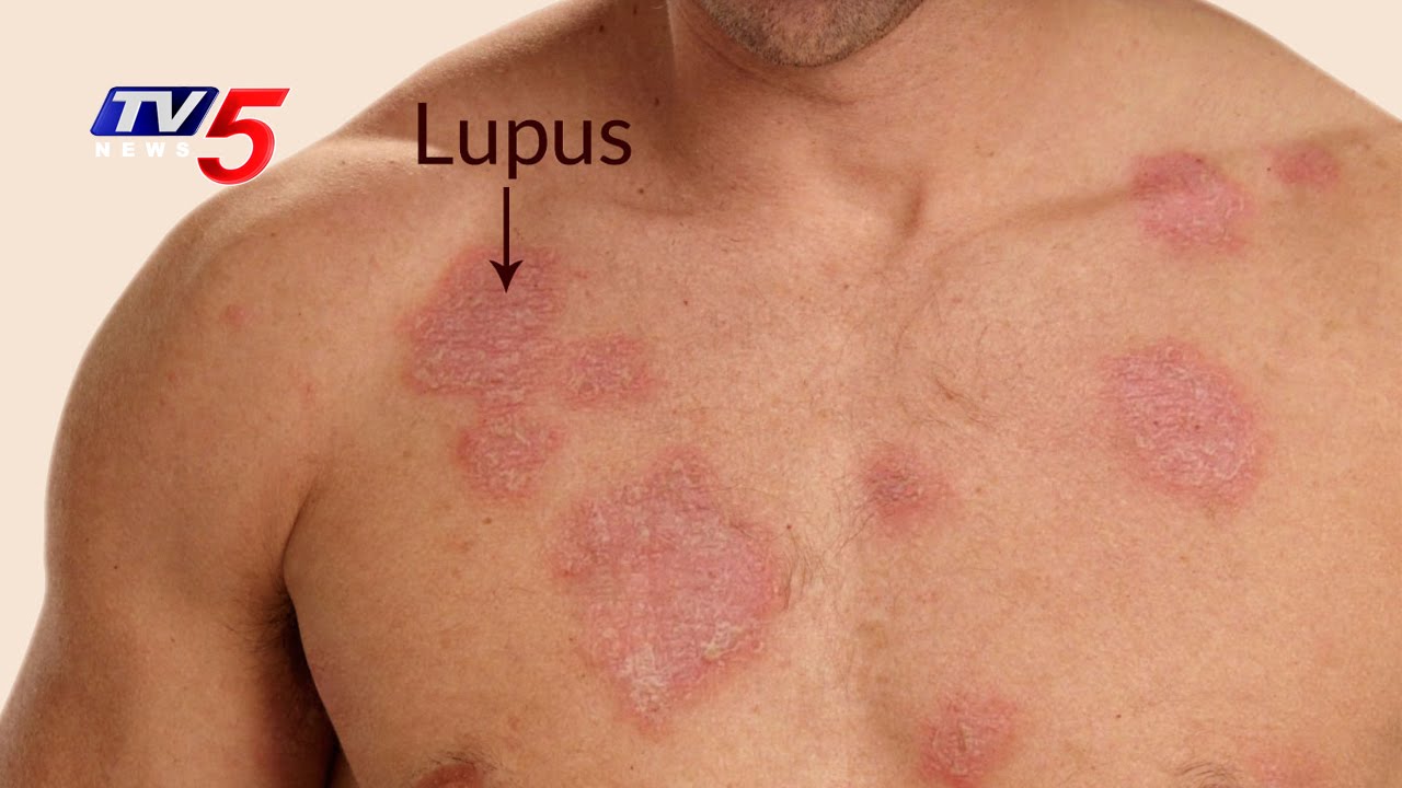 Is lupus what Lupus: Causes,