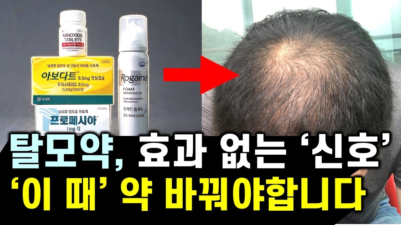 탈모약, 미녹시딜 효과 부족하다면 당장 이렇게 해보세요! 탈모 치료 효과는 약물마다 골든타임이 다릅니다.. (feat. 탈모약, 미녹시딜 효과, 부작용 연구 데이터 공개)