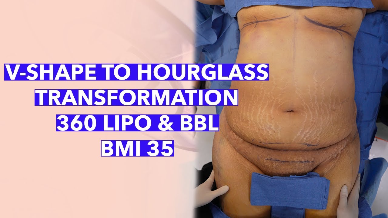 V-Shape To Hourglass Patient Transformation! 360 Lipo with Brazilian ...