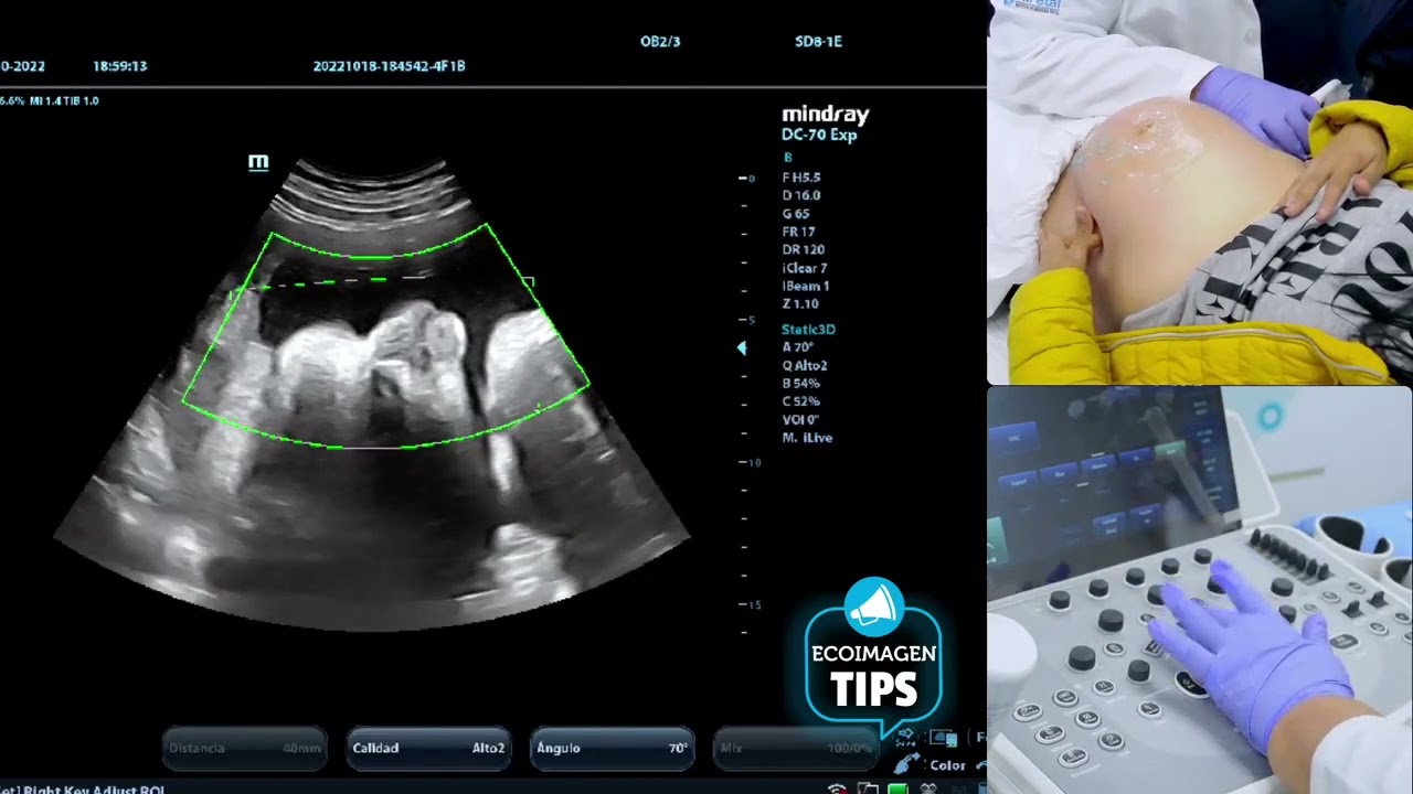 Tips para realizar la cara fetal en 3D con multiplanares