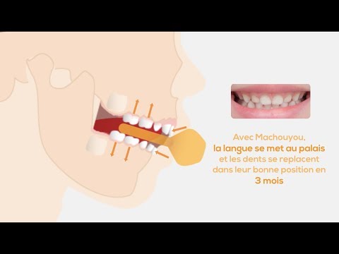 Comment Machouyou réaligne les dents : dessin animé 