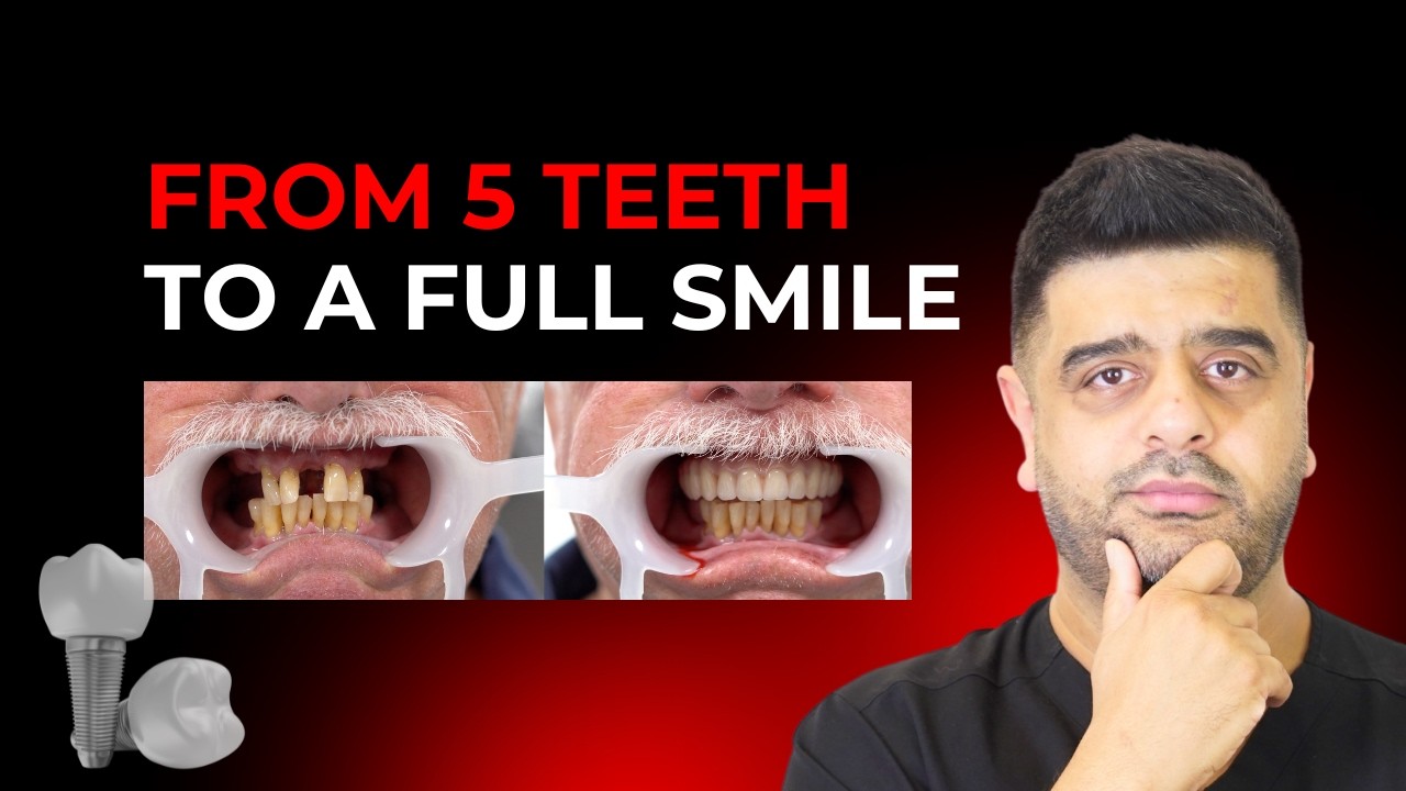 Steve’s Smile Transformation | From 5 Teeth to Full Dental Implants