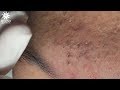 WARNING: A LOT OF BLACKHEADS (PART 1) | Lấy mụn ẩn dưới da, mụn đầu đen | My Linh