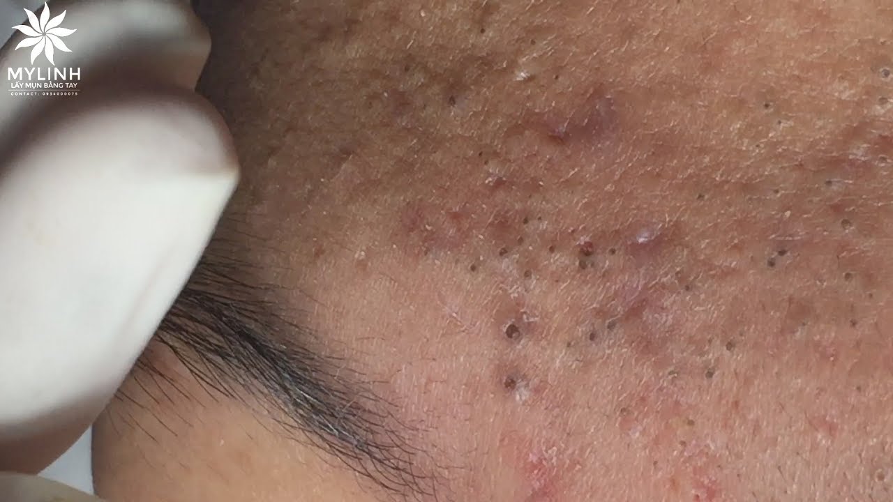 WARNING: A LOT OF BLACKHEADS (PART 1) | Lấy mụn ẩn dưới da, mụn đầu đen | My Linh