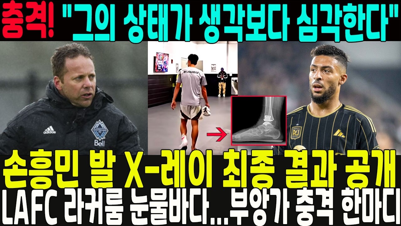 “감독도 결국 울었다” 손흥민 발 X-레이 최종 결과 공개 → LAFC 라커룸 눈물바다… 부앙가 한마디에 팬들 충격: 
