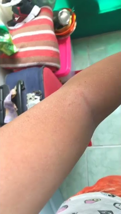Ngeri kulit nya ngelupas pake Hb dosting