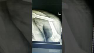 Humerus Bone Fracture 