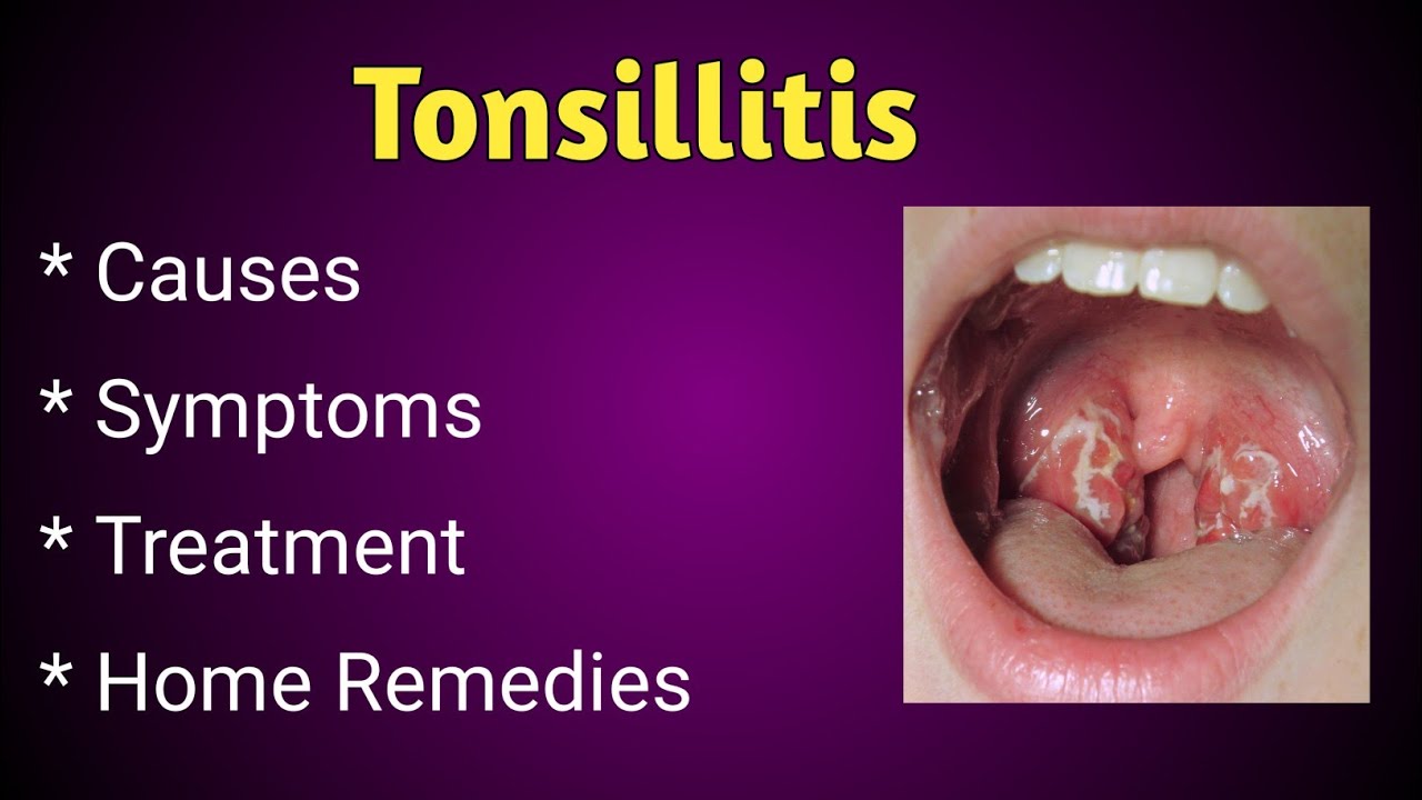 Tonsillitis Causes Symptoms And Treatment YouTube Tonsillitis Causes Symptoms And Treatment YouTube