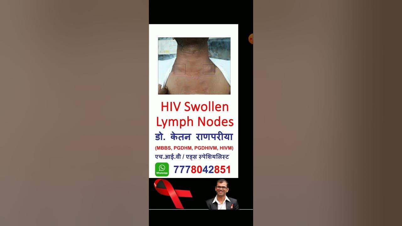 hiv-swollen-lymph-nodes-hiv-lymphocytes-acute-hiv-lymph-nodes-hiv