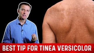 Natural (Skin Fungus) Tinea Versicolor Home Remedies – Dr. Berg - Youtube