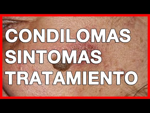 papiloma cáncer de próstata definición papiloma cáncer de próstata definición